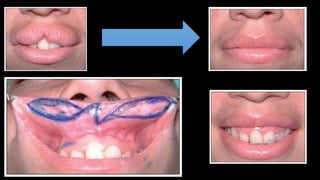 Alteraciones del Desarrollo: Hendidura Labio-Palatina y Labio Doble | PPTX