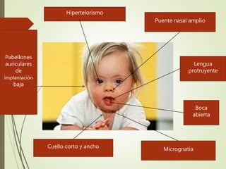 Hipertelorismo
Puente nasal amplio
Pabellones
auriculares
de
implantación
baja
Lengua
protruyente
Boca
abierta
MicrognatiaCuello corto y ancho
 