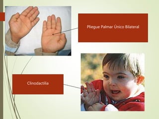 
Pliegue Palmar Único Bilateral
Clinodactilia
 