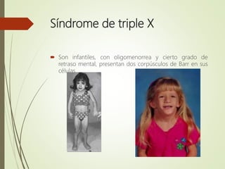 Síndrome de triple X
 Son infantiles, con oligomenorrea y cierto grado de
retraso mental, presentan dos corpúsculos de Barr en sus
células.
 