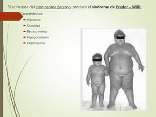 Si se hereda del cromosoma paterno, produce el síndrome de Prader – Willi.
 Características:
 Hipotonía
 Obesidad
 Retraso mental
 Hipogonadismo
 Criptorquidia
 