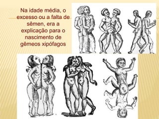 Na idade média, o
excesso ou a falta de
sêmen, era a
explicação para o
nascimento de
gêmeos xipófagos
 