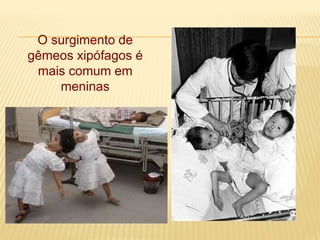 O surgimento de
gêmeos xipófagos é
mais comum em
meninas
 