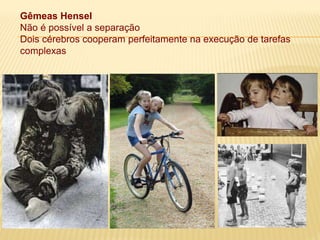 Gêmeas Hensel
Não é possível a separação
Dois cérebros cooperam perfeitamente na execução de tarefas
complexas
 