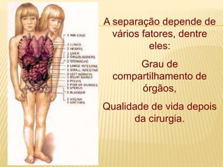 A separação depende de
vários fatores, dentre
eles:
Grau de
compartilhamento de
órgãos,
Qualidade de vida depois
da cirurgia.
 