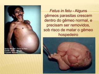Fetus in fetu - Alguns
gêmeos parasitas crescem
dentro do gêmeo normal, e
precisam ser removidos,
sob risco de matar o gêmeo
hospedeiro
 