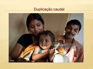 Duplicação caudal
 
