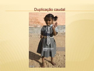 Duplicação caudal
 