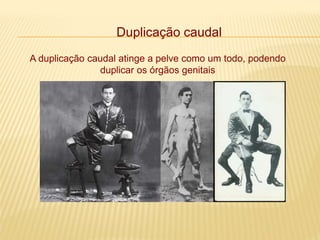 Duplicação caudal
A duplicação caudal atinge a pelve como um todo, podendo
duplicar os órgãos genitais
 