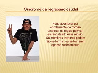 Síndrome da regressão caudal
Pode acontecer por
enrolamento do cordão
umbilical na região pélvica,
estrangulando essa região.
Os membros ineriores podem
não se formar, ou se tornarem
apenas rudimentares
 