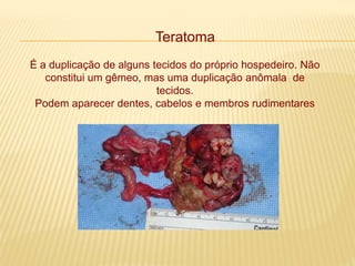 Teratoma
É a duplicação de alguns tecidos do próprio hospedeiro. Não
constitui um gêmeo, mas uma duplicação anômala de
tecidos.
Podem aparecer dentes, cabelos e membros rudimentares
 