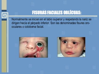 FISURAS FACIALES OBLÍCUAS:   Normalmente se inician en el labio superior y respetando la nariz se dirigen hacía el párpado inferior. Son las denominadas fisuras oro-oculares o coloboma facial.  