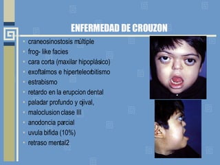 ENFERMEDAD DE CROUZON craneosinostosis múltiple  frog- like facies cara corta (maxilar hipoplásico)  exoftalmos e hiperteleorbitismo estrabismo retardo en la erupcion dental paladar profundo y ojival, maloclusion clase III anodoncia parcial uvula bifida (10%)  retraso mental2 