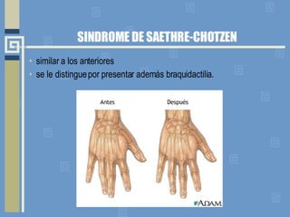 SINDROME DE SAETHRE-CHOTZEN similar a los anteriores se le distingue por presentar además braquidactilia. 