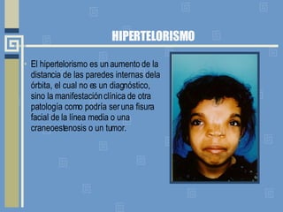 HIPERTELORISMO El hipertelorismo es un aumento de la distancia de las paredes internas de la órbita, el cual no es un diagnóstico, sino la manifestación clínica de otra patología como podría ser una fisura facial de la línea media o una craneoestenosis o un tumor. 