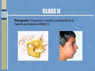 CLASE II Retrognatia :  Proyección o tamaño insuficiente de la mandíbula.Ocasiona ANGLE II.  