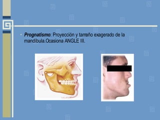 Prognatismo : Proyección y tamaño exagerado de la mandíbula.Ocasiona ANGLE III.  