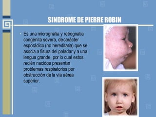 SINDROME DE PIERRE ROBIN Es una micrognatia y retrognatia congénita severa, de carácter esporádico (no hereditaria) que se asocia a fisura del paladar y a una lengua grande, por lo cual estos recién nacidos presentan problemas respiratorios por obstrucción de la vía aérea superior.  