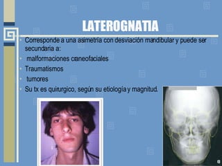 LATEROGNATIA Corresponde a una asimetría con desviación mandibular y puede ser secundaria a: malformaciones craneofaciales Traumatismos tumores Su tx es quirurgico, según su etiología y magnitud. 