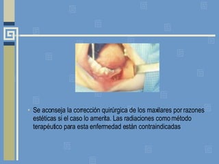 Se aconseja la corrección quirúrgica de los maxilares por razones estéticas si el caso lo amerita. Las radiaciones como método terapéutico para esta enfermedad están contraindicadas 