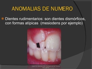 ANOMALIAS DE NUMERO Dientes rudimentarios: son dientes dismórficos, con formas atípicas  (mesiodens por ejemplo) Gorlin RJ, Goldman HM. Patologia oral de Thomas. Edit. Salvat.  