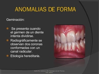ANOMALIAS DE FORMA Geminación: Se presenta cuando el germen de un diente intenta dividirse. Radiográficamente se observan dos coronas conformadas con un canal radicular.  Etiología hereditaria. Gorlin RJ, Goldman HM. Patologia oral de Thomas. Edit. Salvat.  