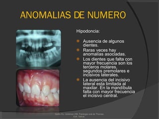 ANOMALIAS DE NUMERO Hipodoncia: Ausencia de algunos dientes.  Raras veces hay anomalías asociadas. Los dientes que falta con mayor frecuencia son los terceros molares, segundos premolares e incisivos laterales.  La ausencia del incisivo lateral esta limitada al maxilar. En la mandíbula falta con mayor frecuencia el incisivo central. Gorlin RJ, Goldman HM. Patologia oral de Thomas. Edit. Salvat.  