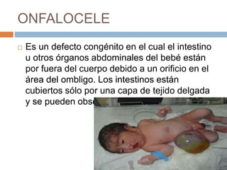 ONFALOCELE 
 Es un defecto congénito en el cual el intestino 
u otros órganos abdominales del bebé están 
por fuera del cuerpo debido a un orificio en el 
área del ombligo. Los intestinos están 
cubiertos sólo por una capa de tejido delgada 
y se pueden observar fácilmente. 
 