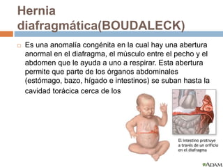 Hernia 
diafragmática(BOUDALECK) 
 Es una anomalía congénita en la cual hay una abertura 
anormal en el diafragma, el músculo entre el pecho y el 
abdomen que le ayuda a uno a respirar. Esta abertura 
permite que parte de los órganos abdominales 
(estómago, bazo, hígado e intestinos) se suban hasta la 
cavidad torácica cerca de los pulmones. 
 