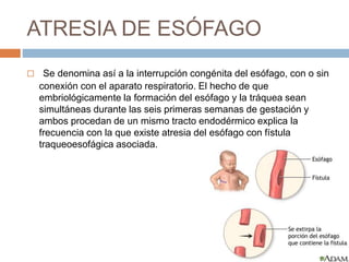 ATRESIA DE ESÓFAGO 
 Se denomina así a la interrupción congénita del esófago, con o sin 
conexión con el aparato respiratorio. El hecho de que 
embriológicamente la formación del esófago y la tráquea sean 
simultáneas durante las seis primeras semanas de gestación y 
ambos procedan de un mismo tracto endodérmico explica la 
frecuencia con la que existe atresia del esófago con fístula 
traqueoesofágica asociada. 
 