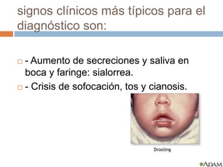 signos clínicos más típicos para el 
diagnóstico son: 
 - Aumento de secreciones y saliva en 
boca y faringe: sialorrea. 
 - Crisis de sofocación, tos y cianosis. 
 