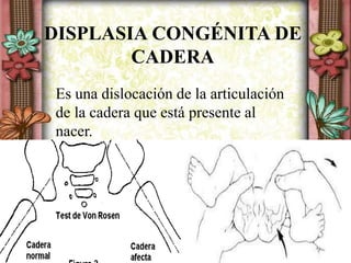 DISPLASIA CONGÉNITA DE
CADERA
Es una dislocación de la articulación
de la cadera que está presente al
nacer.
 