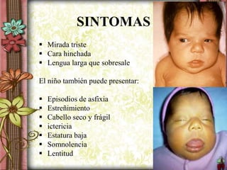 SINTOMAS
 Mirada triste
 Cara hinchada
 Lengua larga que sobresale
El niño también puede presentar:
 Episodios de asfixia
 Estreñimiento
 Cabello seco y frágil
 ictericia
 Estatura baja
 Somnolencia
 Lentitud
 