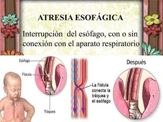 Interrupción del esófago, con o sin
conexión con el aparato respiratorio
ATRESIA ESOFÁGICA
 