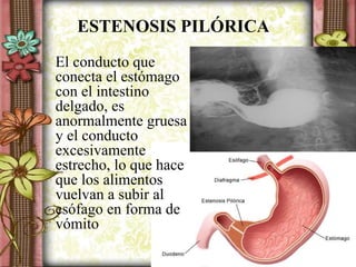 ESTENOSIS PILÓRICA
El conducto que
conecta el estómago
con el intestino
delgado, es
anormalmente gruesa
y el conducto
excesivamente
estrecho, lo que hace
que los alimentos
vuelvan a subir al
esófago en forma de
vómito
 