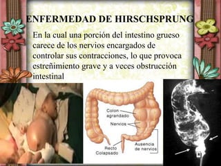 En la cual una porción del intestino grueso
carece de los nervios encargados de
controlar sus contracciones, lo que provoca
estreñimiento grave y a veces obstrucción
intestinal
ENFERMEDAD DE HIRSCHSPRUNG
 