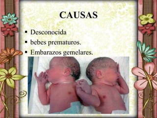 CAUSAS
 Desconocida
 bebes prematuros.
 Embarazos gemelares.
 