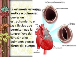La estenosis valvular
aórtica o pulmonar,
que es un
estrechamiento en
las válvulas que
permiten que la
sangre fluya del
corazón a los
pulmones y otras
partes del cuerpo.
 