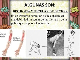 ALGUNAS SON:
DISTROFIA MUSCULAR DE BECKER
Es un trastorno hereditario que consiste en
una debilidad muscular de las piernas y de la
pelvis que empeora lentamente.
 