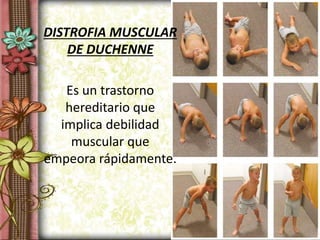 DISTROFIA MUSCULAR
DE DUCHENNE
Es un trastorno
hereditario que
implica debilidad
muscular que
empeora rápidamente.
 