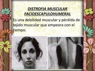 DISTROFIA MUSCULAR
FACIOESCAPULOHUMERAL
Es una debilidad muscular y pérdida de
tejido muscular que empeora con el
tiempo.
 