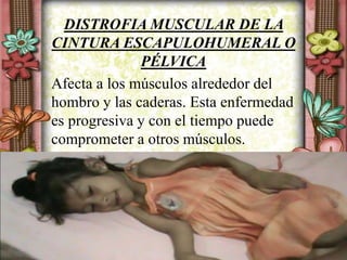 DISTROFIA MUSCULAR DE LA
CINTURA ESCAPULOHUMERAL O
PÉLVICA
Afecta a los músculos alrededor del
hombro y las caderas. Esta enfermedad
es progresiva y con el tiempo puede
comprometer a otros músculos.
 