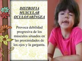 DISTROFIA
MUSCULAR
OCULOFARÍNGEA
Provoca debilidad
progresiva de los
músculos situados en
las proximidades de
los ojos y la garganta.
 