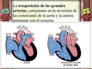 La trasposición de las grandes
arterias, consistente en la inversión de
las conexiones de la aorta y la arteria
pulmonar con el corazón.
 