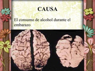 CAUSA
El consumo de alcohol durante el
embarazo
 