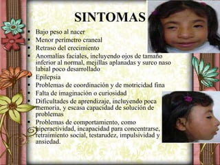 SINTOMAS
 Bajo peso al nacer
 Menor perímetro craneal
 Retraso del crecimiento
 Anomalías faciales, incluyendo ojos de tamaño
inferior al normal, mejillas aplanadas y surco naso
labial poco desarrollado
 Epilepsia
 Problemas de coordinación y de motricidad fina
 Falta de imaginación o curiosidad
 Dificultades de aprendizaje, incluyendo poca
memoria, y escasa capacidad de solución de
problemas
 Problemas de comportamiento, como
hiperactividad, incapacidad para concentrarse,
retraimiento social, testarudez, impulsividad y
ansiedad.
 