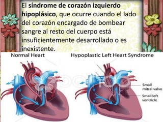El síndrome de corazón izquierdo
hipoplásico, que ocurre cuando el lado
del corazón encargado de bombear
sangre al resto del cuerpo está
insuficientemente desarrollado o es
inexistente.
 