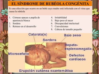 EL SÍNDROME DE RUBÉOLA CONGÉNITA
Es una afección que ocurre en un bebé cuya madre está infectada con el virus que
causa la rubéola
1. Córneas opacas o pupila de
apariencia blanca
2. Sordera
3. Retraso en el desarrollo
4. Irritabilidad
5. Bajo peso al nacer
6. Discapacidad intelectual
7. Convulsiones
8. Cabeza de tamaño pequeño
 