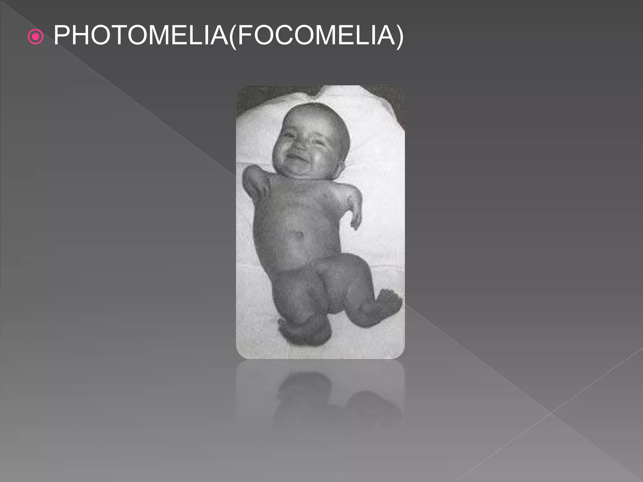 Fucomelia Anomalias congenitas del desarrollo | PPTX