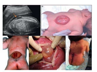 *1 de c/1000 RN
ESPINA BÍFIDA QUÍSTICA
• Los tipos graves de espina bífida, comprenden un prolapso
de la medula espinal y/o meninges a través de los defectos
de los arcos vertebrales.
• Cuando el saco contiene meninges y LCR se denomina:
espina bífida con meningocele (raíces y medula en posición
normal).
• Cuando hay compromiso de raíces y medula, se denomina
espina bífida con mielomenigocele.
• Los casos graves de espina bífida con mielomenigocele que
afecta a varias vertebras, se asocia a menudo a una
ausencia parcial del encéfalo: MEROENCEFALIA.
• Suele haber ausencia se sensibilidad en el dermatoma
afectado, parálisis parcial o completa de musculo estriado y
liso.
• Debe sospecharse durante el embarazo, cuando existen
concentraciones elevadas de la AFP en el liquido amniótico o
sangre materna.
• Ecografía; masa quística, semana 10-12.
 